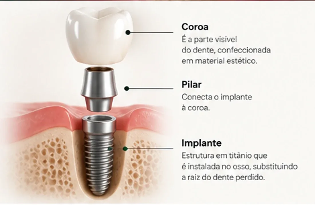 Ilustração didática mostrando coroa, pilar e implante dentário