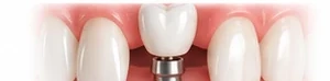Ilustração de implante para reposição de um único dente